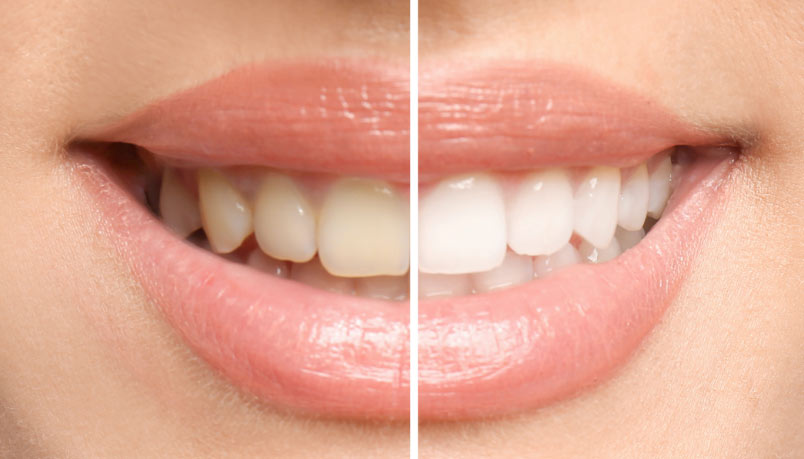 Teeth Whitening